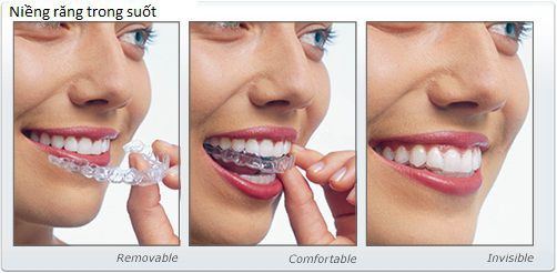 Phẫu thuật hàm hô kết hợp niềng răng
