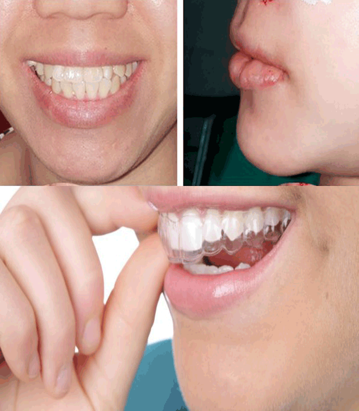 Phẫu thuật hàm hô kết hợp niềng răng